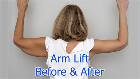 Brachioplasty & Arm Lift .